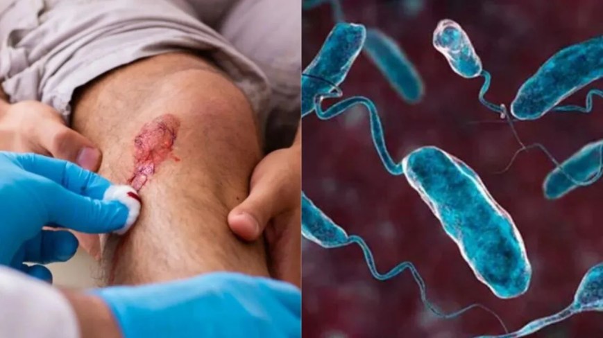 Alertan por la presencia de bacteria «come carne»